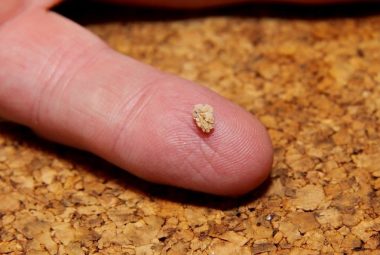 What Is A Kidney Stone