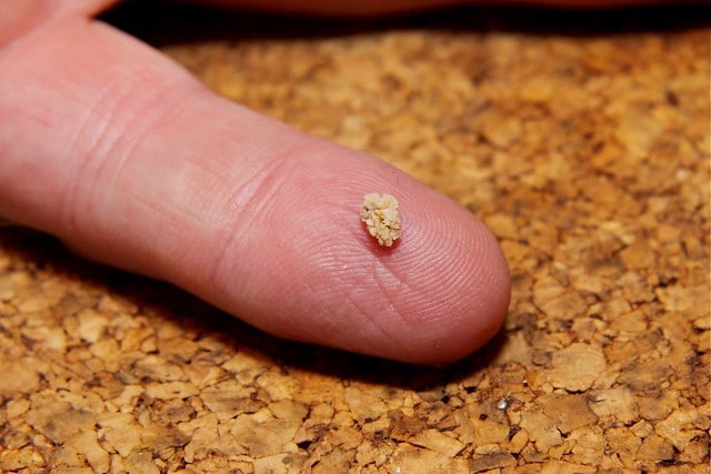what is a kidney stone