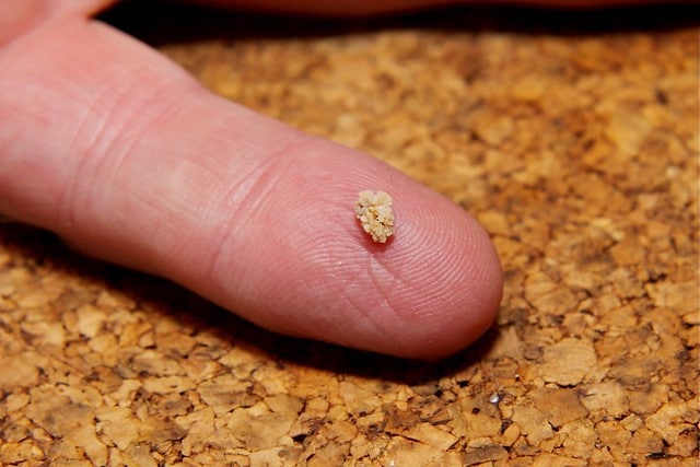 What Is A Kidney Stone